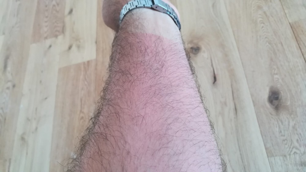 Bras brulé par l'acide